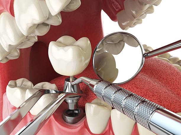 Best Emergency Root Canal Treatment in Park Hills, KY